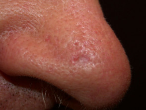 basal cell carcinoma nose scar