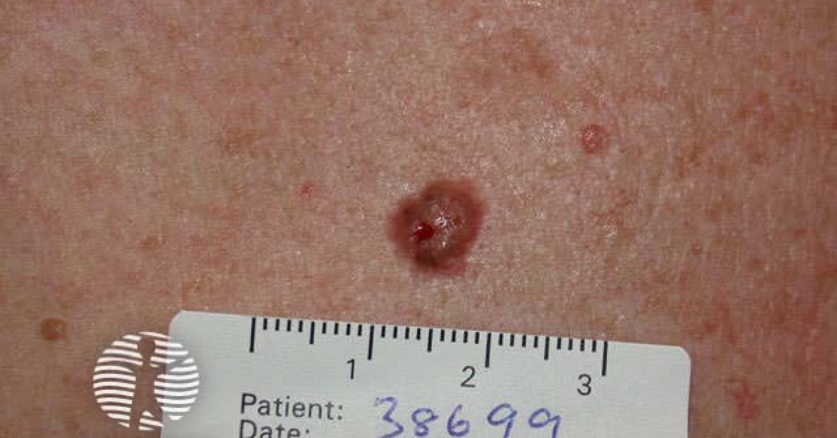 Basal Cell Carcinoma Image 9383