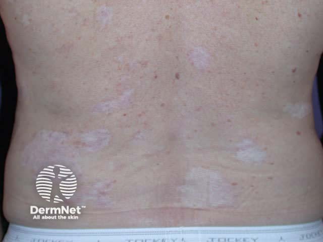 Cryotherapy marks