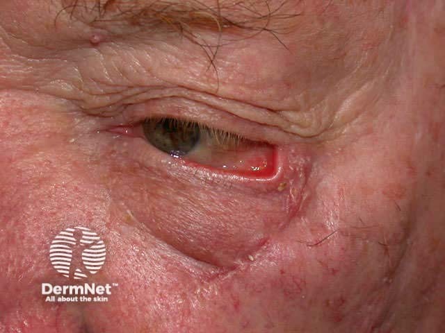 Ectropion due to excision