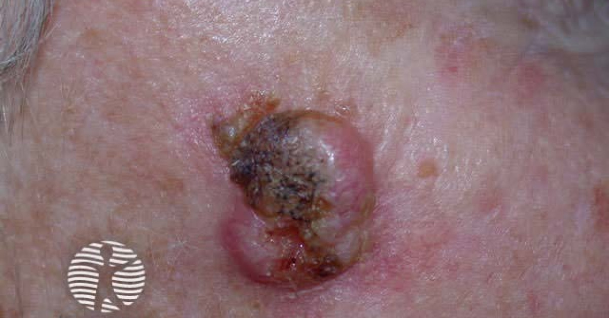 Basal cell carcinoma image