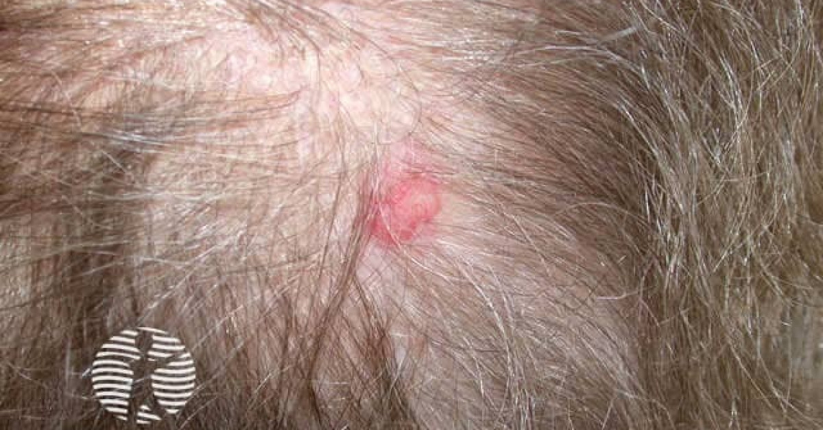 Basal cell carcinoma image