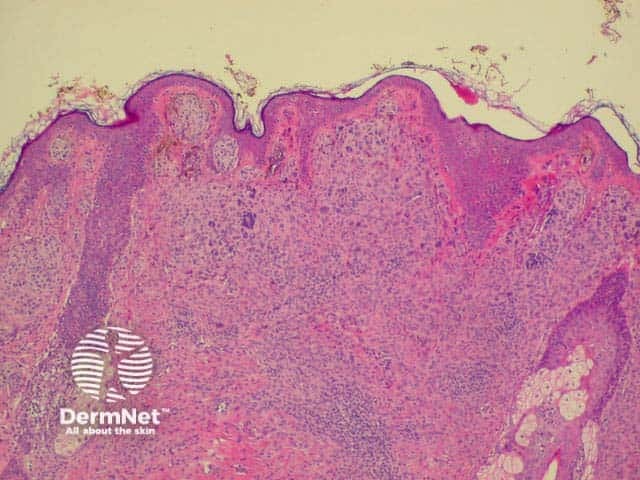 Histology of intradermal naevus