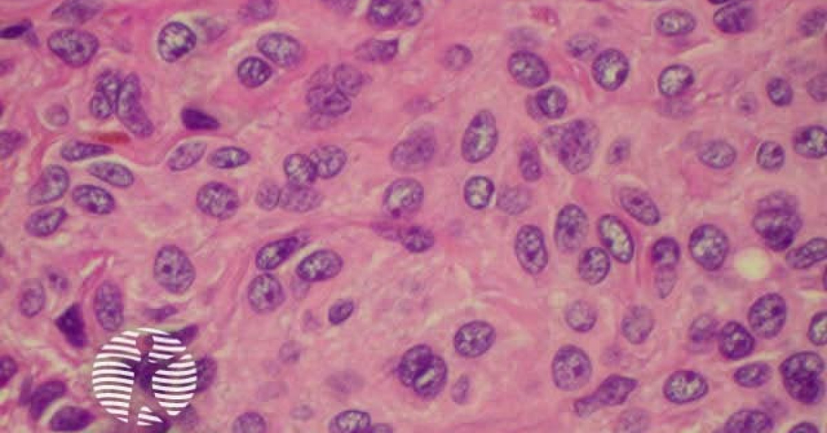 Melanocytic naevus image