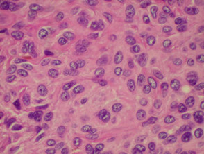 Melanocytic naevus