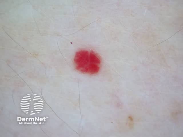 Dermoscopy of cherry angioma