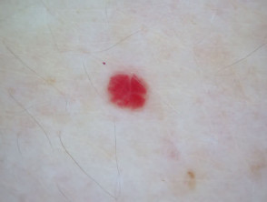 Cherry angioma