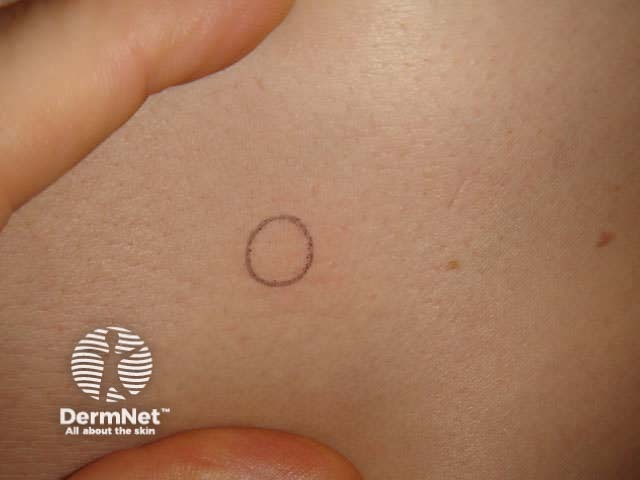 Circle on stretched skin