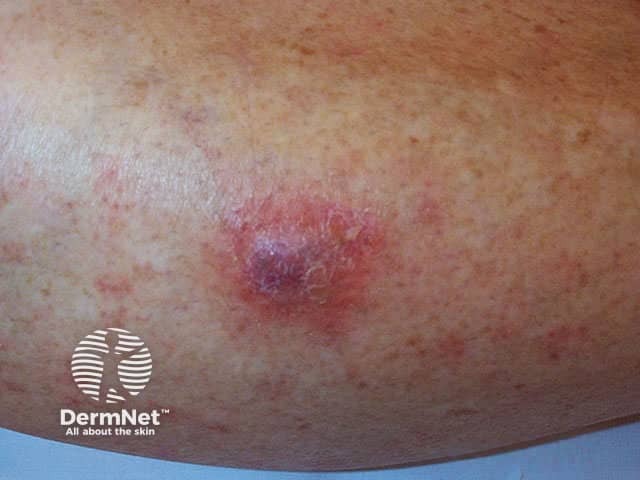 Erythema and swelling an