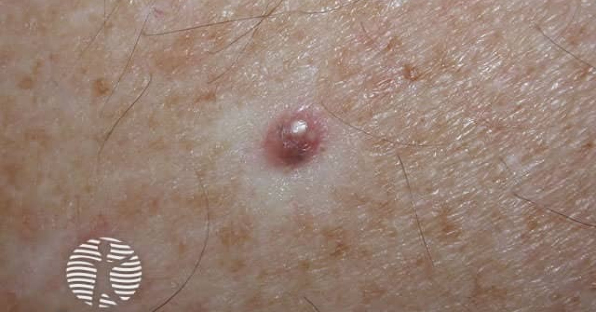 Cryotherapy image