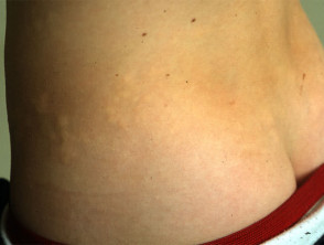 Collagenoma (shagreen patch)