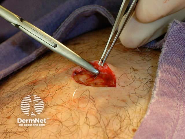 Subcutaneous suture