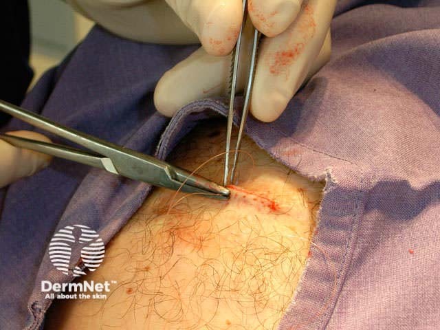Continuous suture
