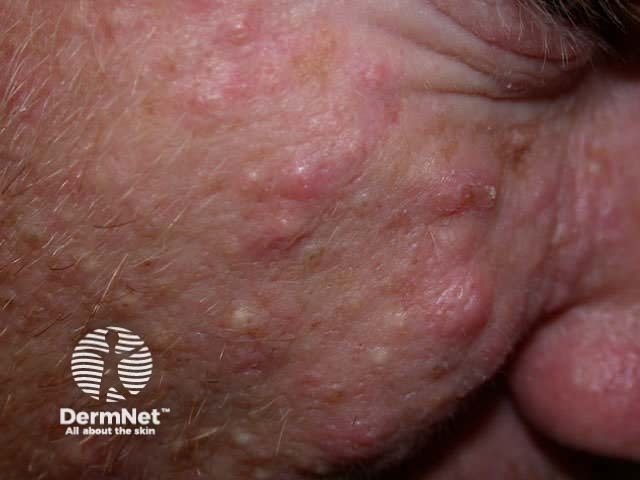 Inflamed cysts in