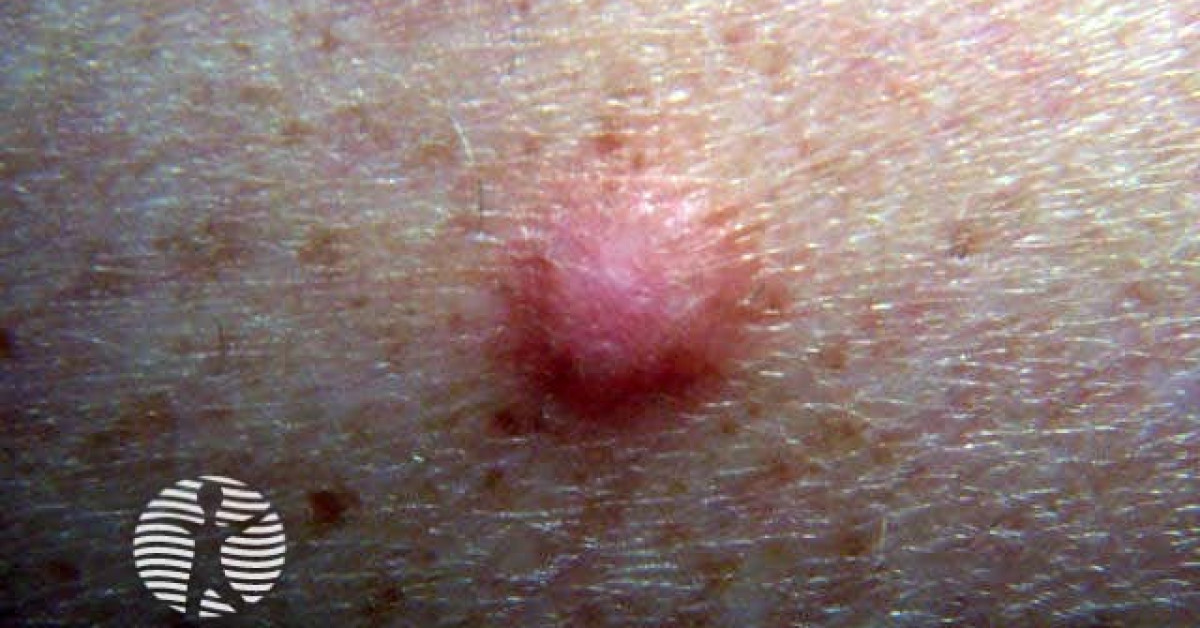 dermatofibroma-benign-skin-lesion-usually-present-with-a-small-firm