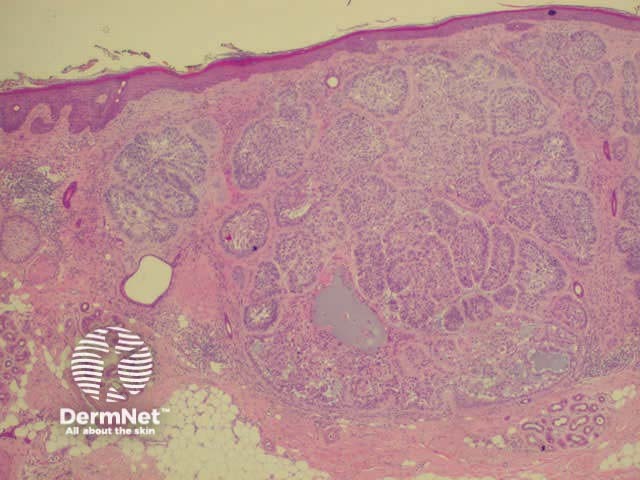 Histology of basal cell carcinoma