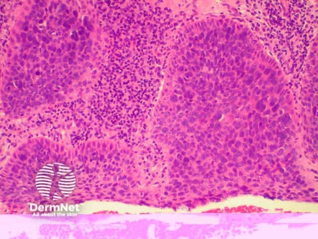 Actinic keratosis