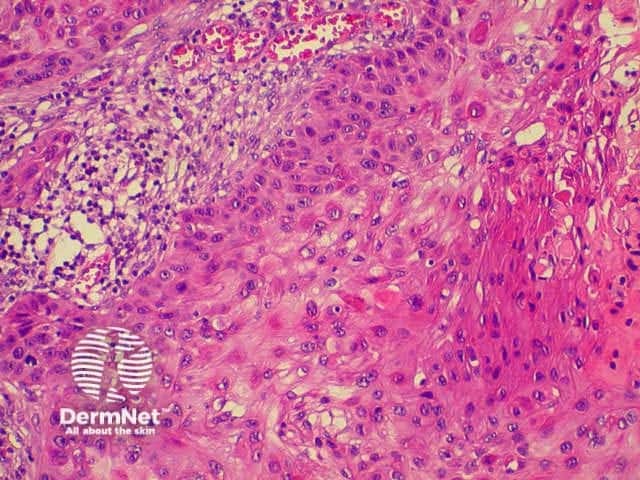 Squamous cell carcinoma