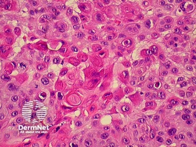 Squamous cell carcinoma