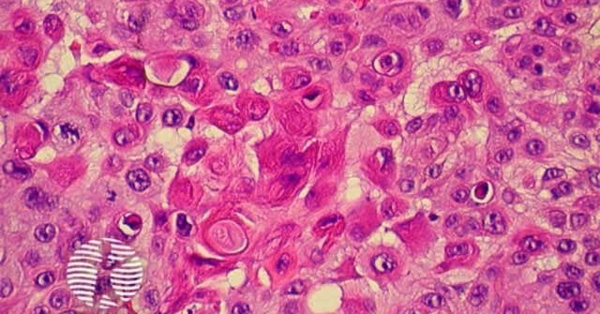 Squamous cell carcinoma image