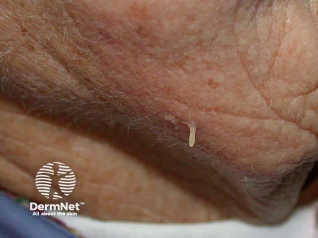 Cutaneous horn