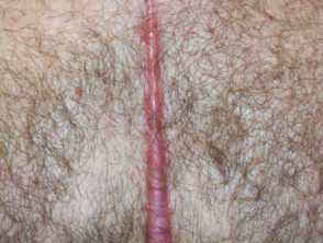 Scar after coronary artery bypass
