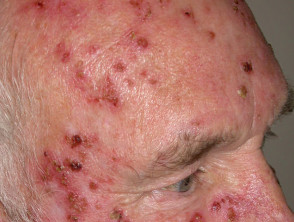 topical lesions imiquimod