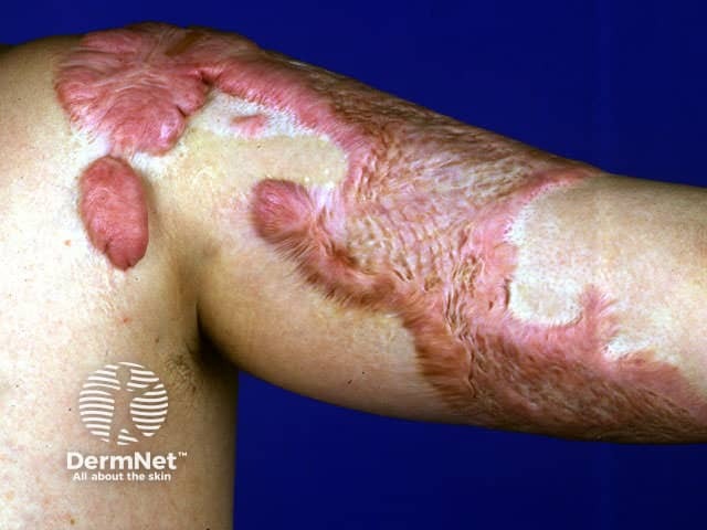 Keloid due to burns