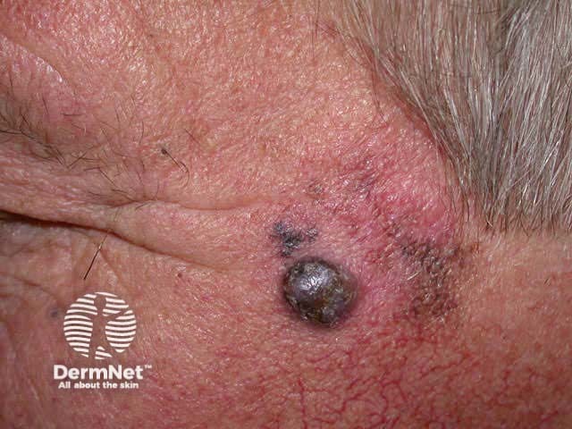 Nodule within LM melanoma