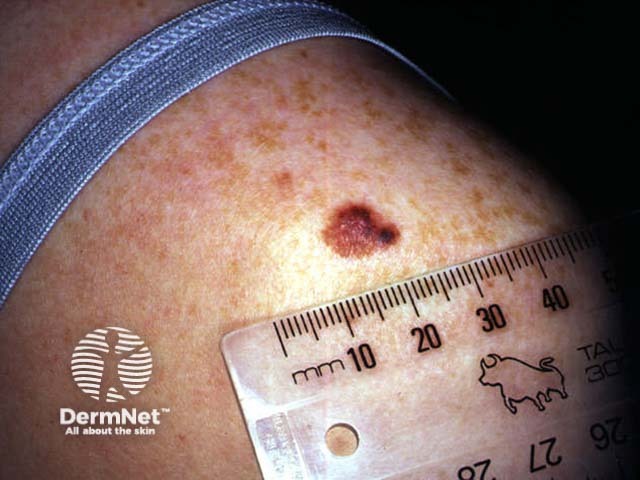 Childhood melanoma