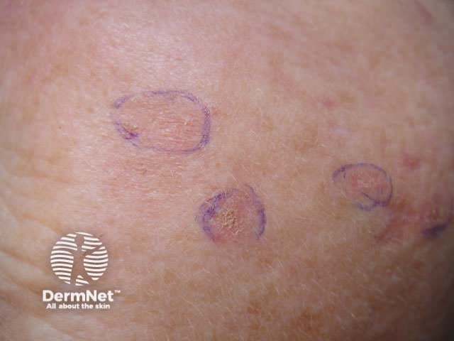 Keratoses marked out for PDT