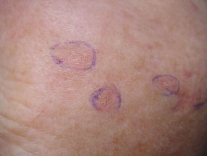 Keratoses marked out for PDT