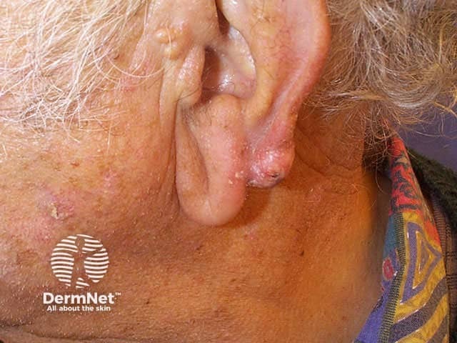 Squamous cell carcinoma