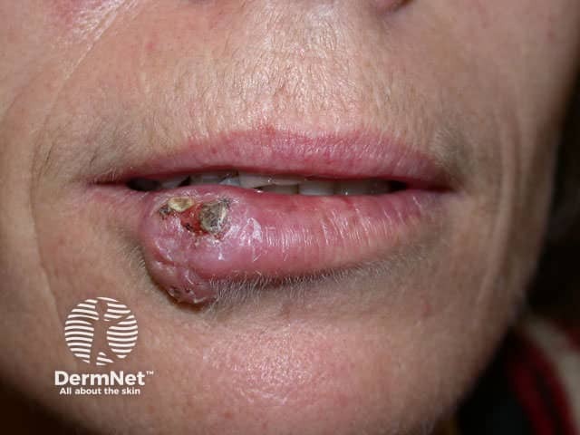 Squamous cell carcinoma of the lip