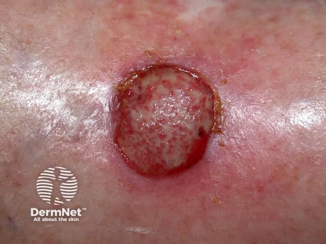 Squamous cell carcinoma