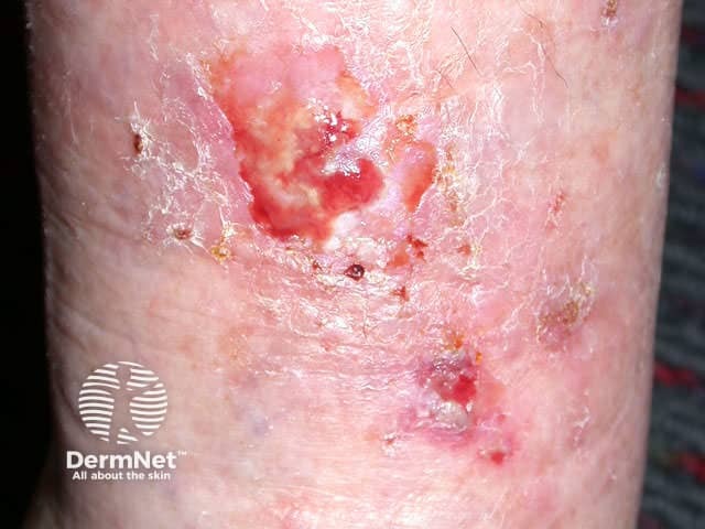 Squamous cell carcinoma