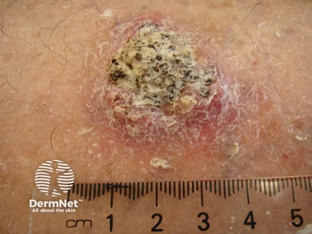 Squamous cell carcinoma