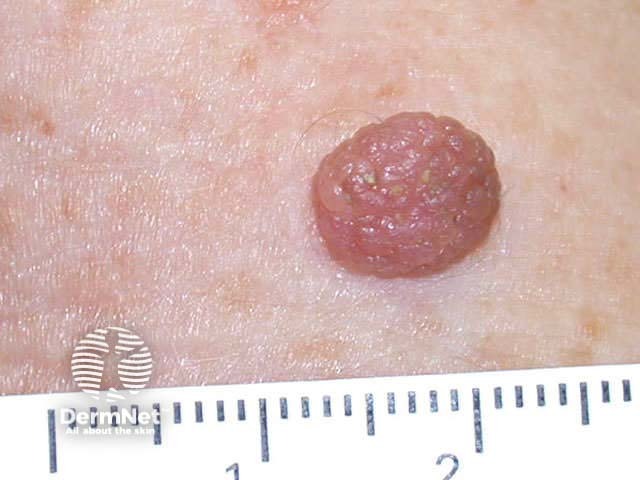 Papillomatous mole