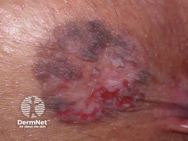 In situ squamous cell carcinoma