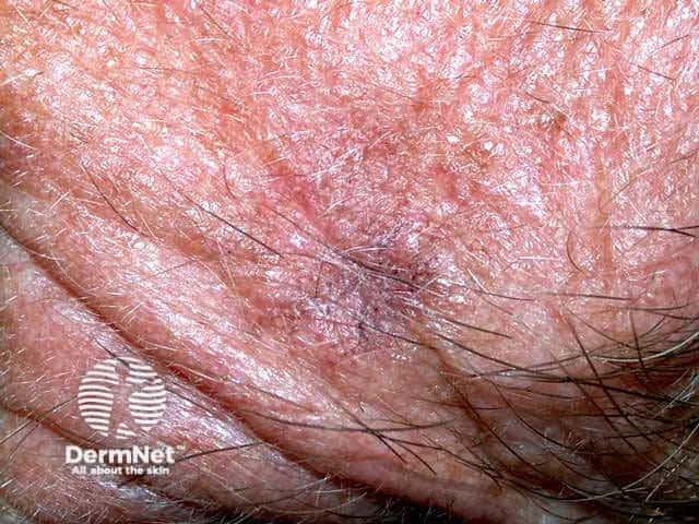 Pigmented actinic keratosis