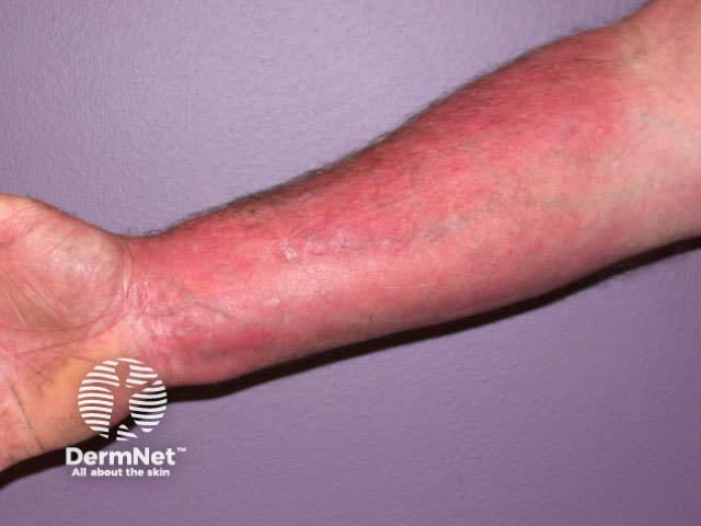 Redness and swelling of the forearm after abrupt discontinuation of prolonged potent topical steroid use. Palms are not affected (red sleeve sign).
