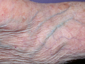 Thin transparent and wrinkled skin