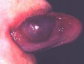 Cavernous lymphangioma