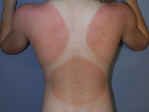 Skin phototype 2: sunburn