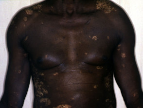 Skin phototype 6, showing early vitiligo