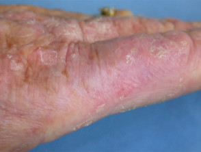 Actinic keratosis treated by PDT