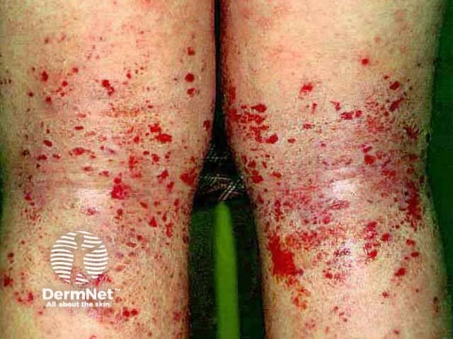 Atopic dermatitis