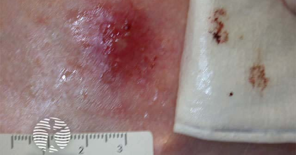 Reactions to PDT at 7 days image