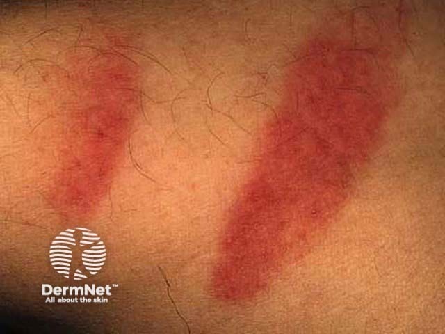 Berloque dermatitis