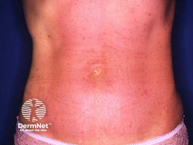 UVB phototherapy burn 24 hrs after an exposure - protocols are designed to minimise the risk of this occurring